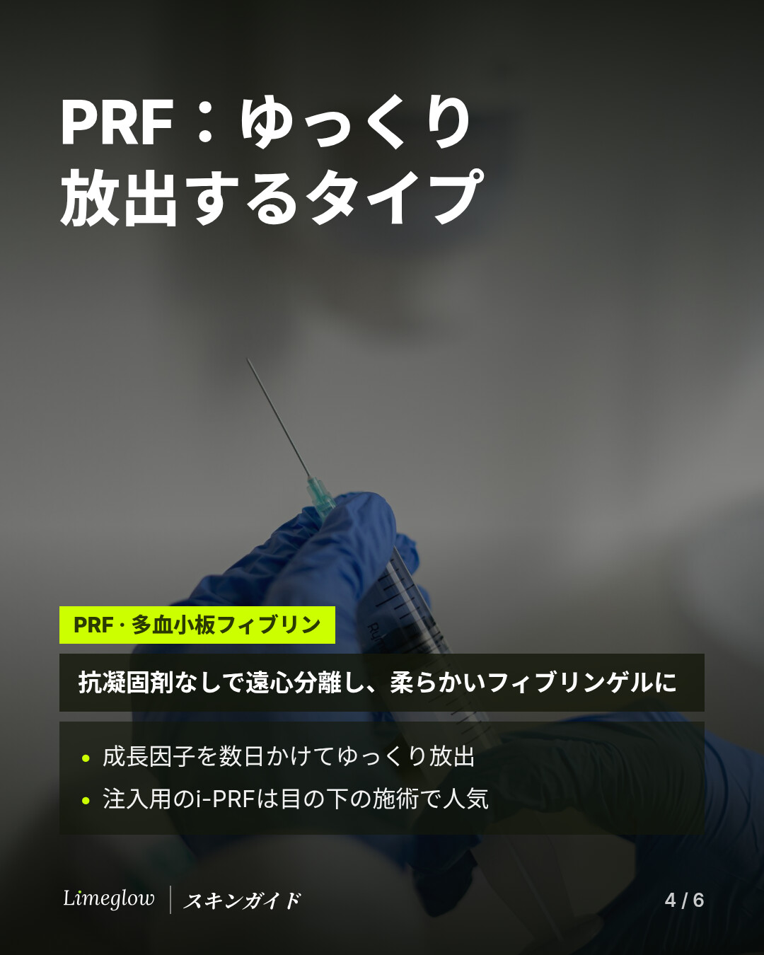 PRF（多血小板フィブリン）は、抗凝固剤を使わずに遠心分離し、やわらかいフィブリンのゲルにしたものです。成長因子をゆっくり放出します。注入用のi-PRFは目の下の施術で人気です。