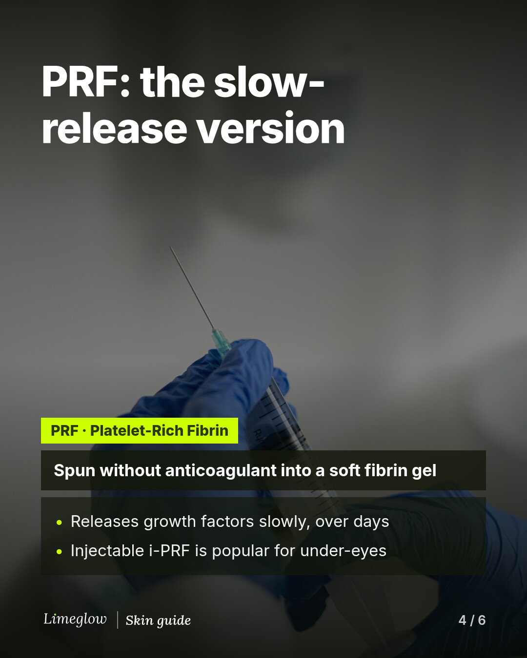 PRF, platelet-rich fibrin, is spun without anticoagulant into a soft fibrin gel. It releases growth factors slowly. Injectable i-PRF is popular for the under-eye area.