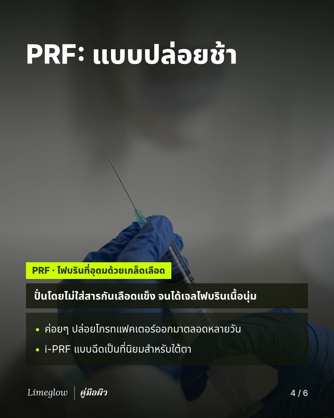 PRF หรือไฟบรินที่อุดมด้วยเกล็ดเลือด ได้จากการปั่นเลือดโดยไม่ใส่สารกันเลือดแข็ง จนได้เจลไฟบรินเนื้อนุ่ม ซึ่งจะค่อยๆ ปล่อยโกรทแฟคเตอร์ออกมา i-PRF แบบฉีดเป็นที่นิยมสำหรับบริเวณใต้ตา