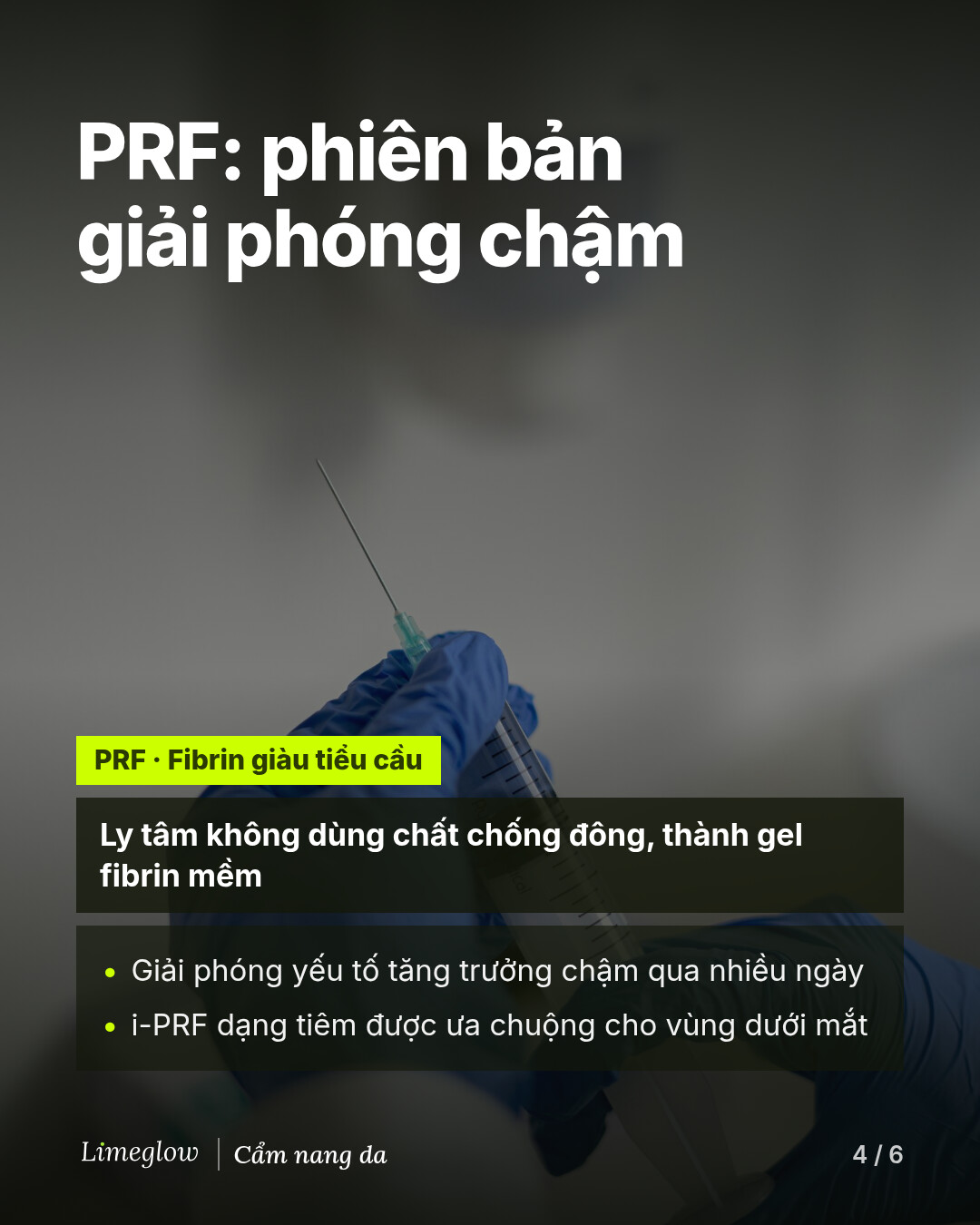 PRF, fibrin giàu tiểu cầu, được quay ly tâm không dùng chất chống đông để tạo thành gel fibrin mềm. PRF giải phóng yếu tố tăng trưởng từ từ. Dạng tiêm i-PRF được ưa chuộng cho vùng dưới mắt.