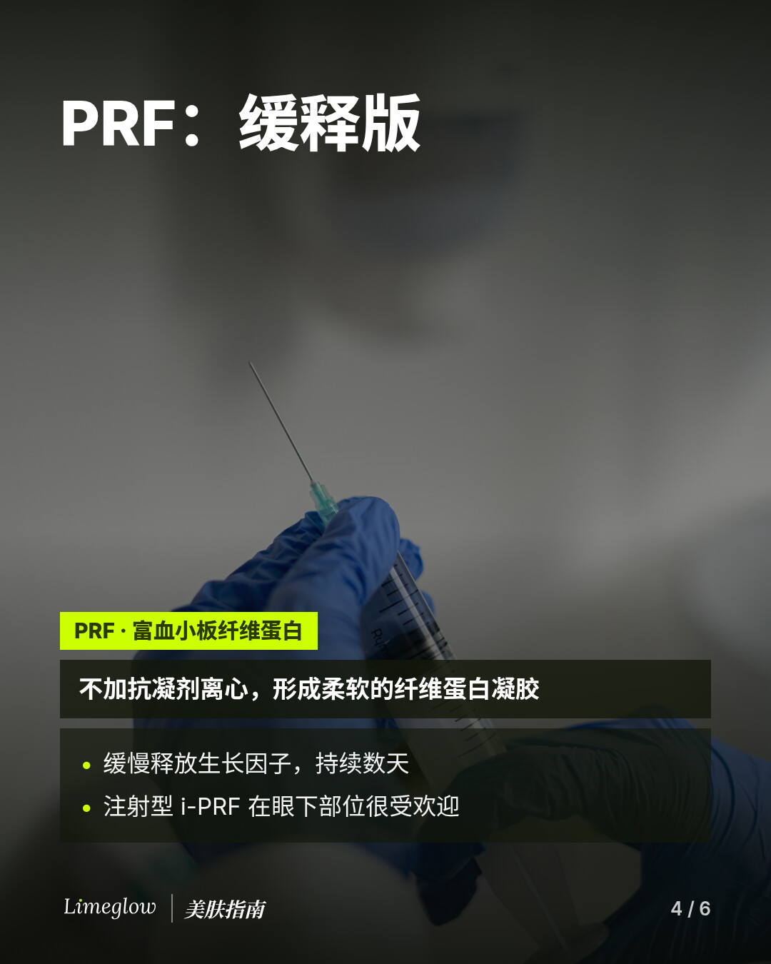 PRF 即富血小板纤维蛋白，在不加抗凝剂的情况下离心，形成柔软的纤维蛋白凝胶，会缓慢释放生长因子。注射型 i-PRF 在眼下部位很受欢迎。