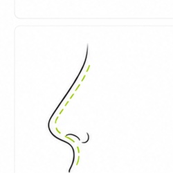 Nasal Tip Surgery treatment at SNU Plastic Surgery Seoul Korea