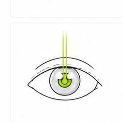SMILE Pro treatment at Gangnam Grand Eye Clinic Seoul Korea