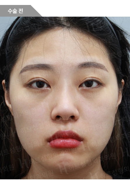 ビフォー — Anti-aging Lifting