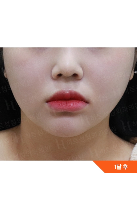 アフター — Anti-aging Lifting