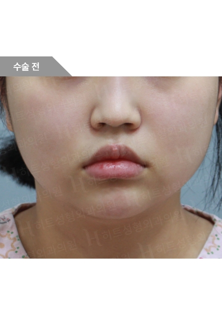ビフォー — Anti-aging Lifting
