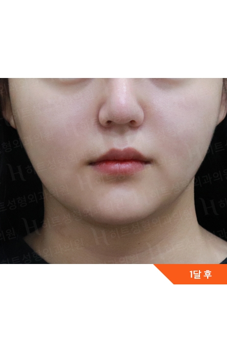 アフター — Anti-aging Lifting