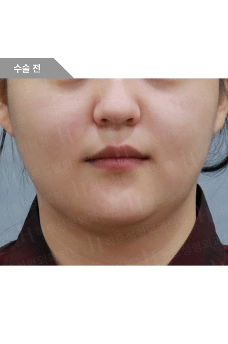 ビフォー — Anti-aging Lifting