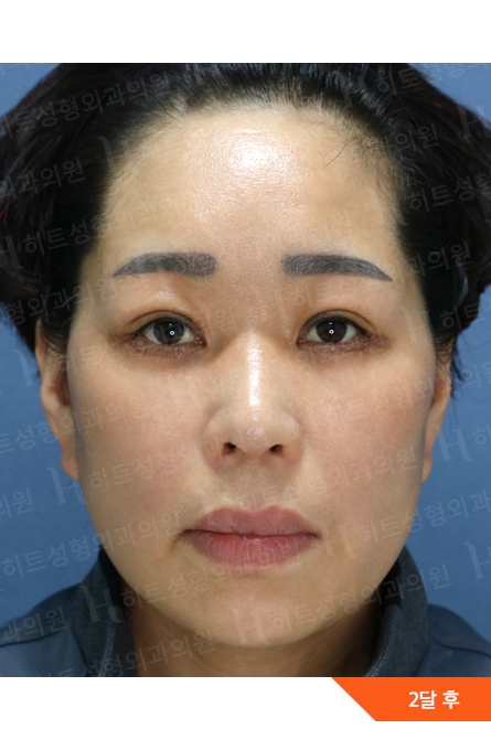 アフター — Anti-aging Lifting