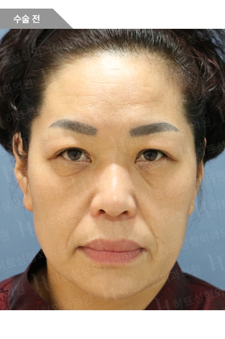 ビフォー — Anti-aging Lifting
