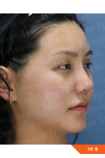 アフター — Anti-aging Lifting