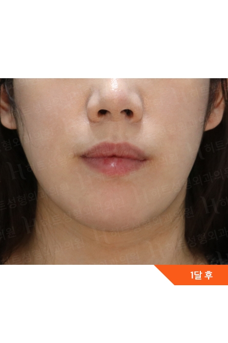 アフター — Anti-aging Lifting