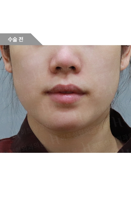 ビフォー — Anti-aging Lifting