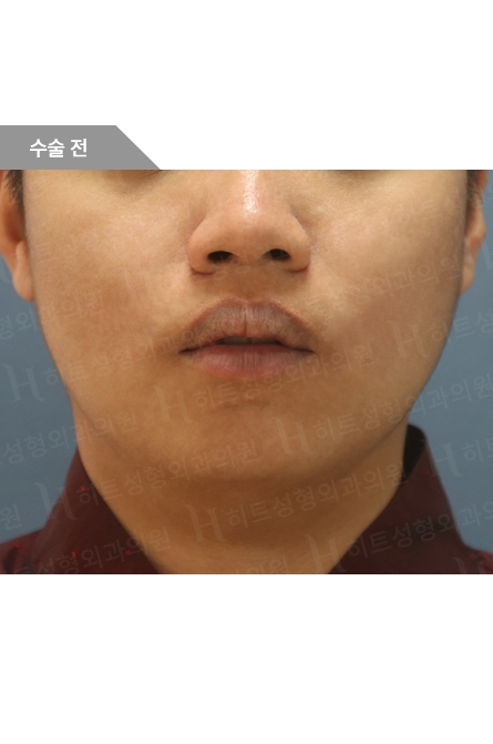 ビフォー — Anti-aging Lifting